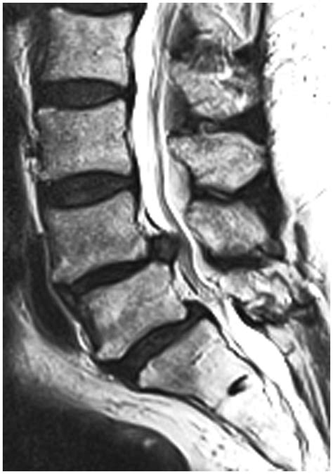 Herniated Disc Thoracic Mri