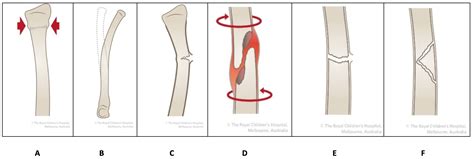 Paediatric & Children's Fractures - Description