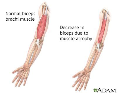 Muscle atrophy Information | Mount Sinai - New York