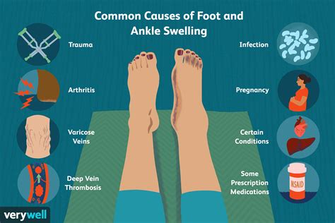 Swollen Ankles And Pregnancy : How To Deal With Swollen Feet During ...