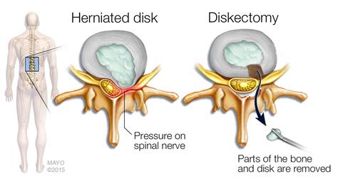 Mayo Clinic Q and A: Herniation can happen to a disk for a number of ...