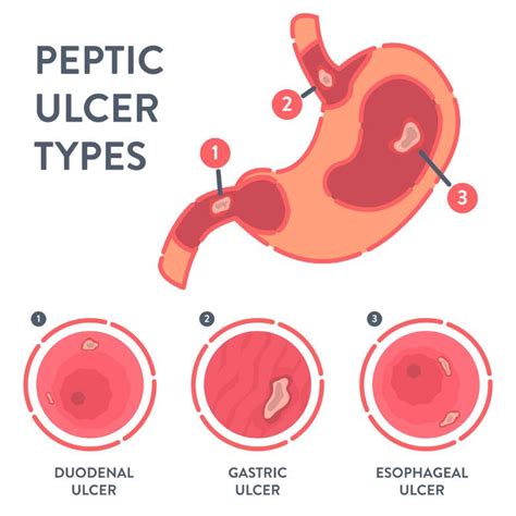 Peptic Ulcers - Symptoms & Causes | Gleneagles Hospital