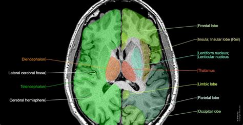 Brain MRI 3D: normal anatomy | e-Anatomy