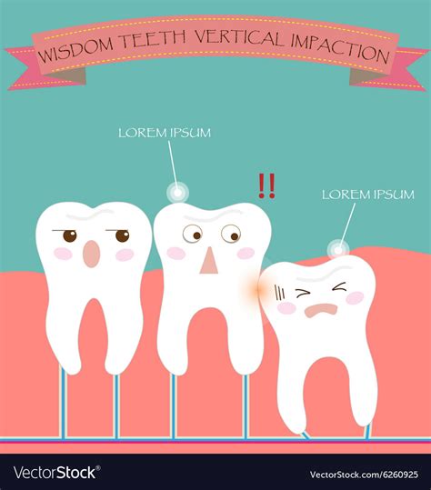 Wisdom teeth vertical impaction Royalty Free Vector Image