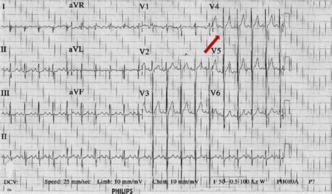 Electrocardiogram showing a right axis deviation with a deep S wave in ...