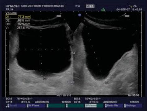 (Ch:06) Ultrasound of the urinary bladder – EFSUMB