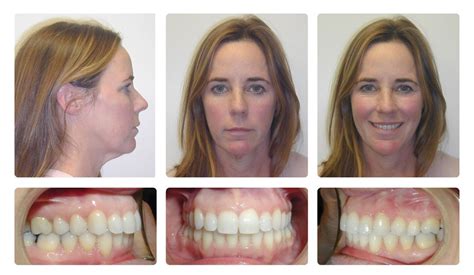 Invisalign Jaw Alignment Before And After | Before And After