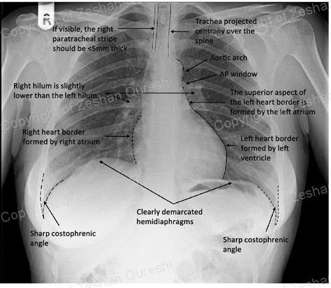 Heart On Chest X Ray Anatomy