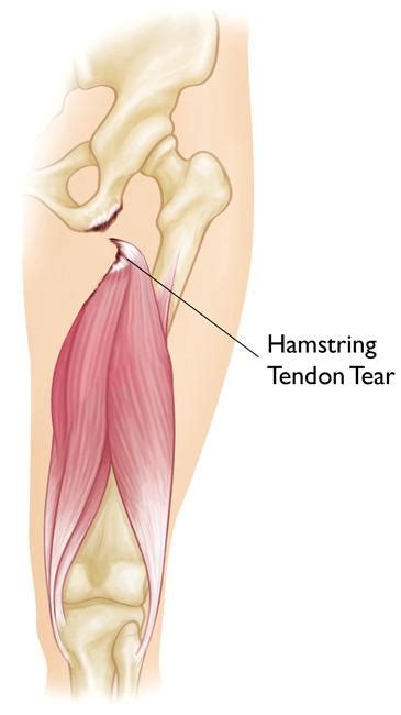 Hamstring Injury Treatment - Hamstring Strain What Is It What Can I Do ...