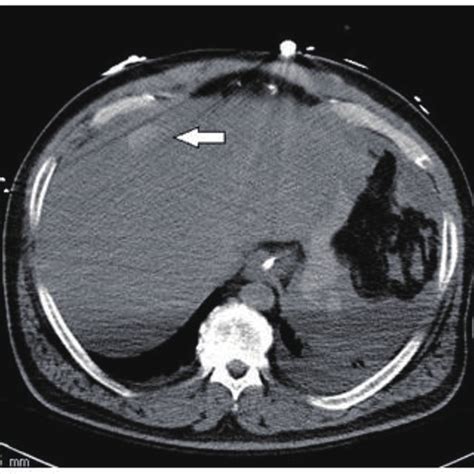 Non-contrast CT scan showing intraperitoneal hemoperitoneum extending... | Download Scientific ...