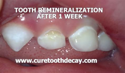 Tooth Remineralization