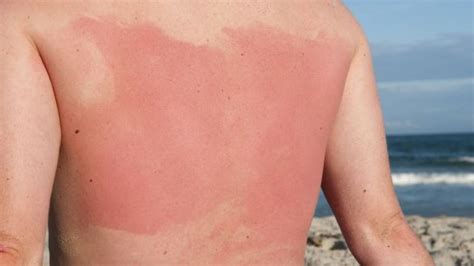 Spot This Rash–Summertime– Sun Sensitivity - Sutton Dermatology + Aesthetics Ctr