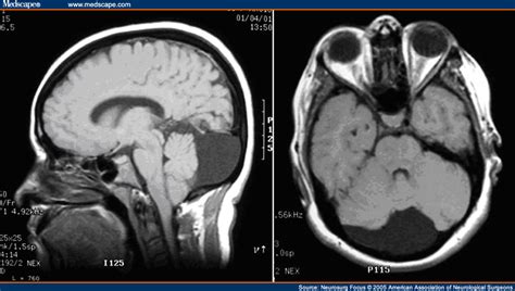 RadiologySpirit: Arachnoid cyst