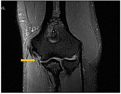 Ulnar Collateral Ligament Wrist Mri