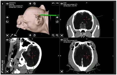 Hydrocephalus Shunt Mri