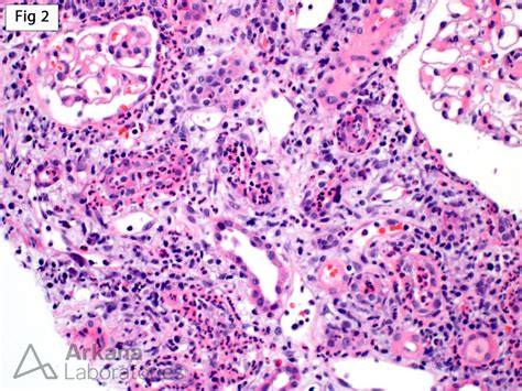 Acute Pyelonephritis in Transplants | Teaching Points | Arkana Labs