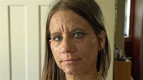 Rare Skin Disease Leaves Woman Covered In Almost 6,000 Tumours | HuffPost UK Life