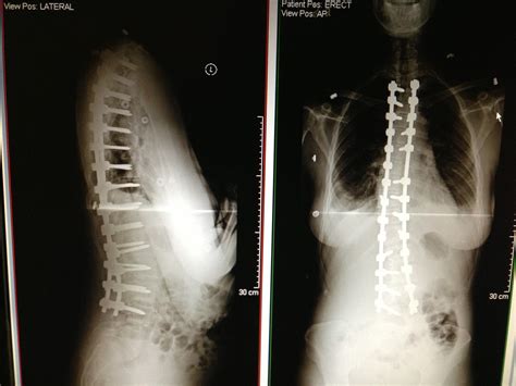 scoliosis surgery | The Stork and the Beanstalk