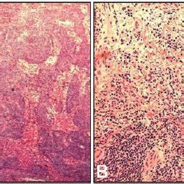 Pathology of a sentinel lymph node. (A) In frozen biopsy, no tumor cell... | Download Scientific ...