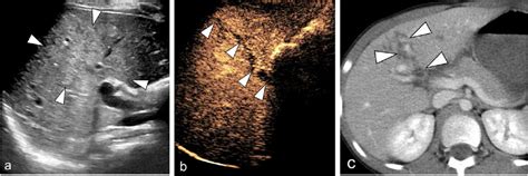 Liver laceration in an 8-year-old boy with a bicycle handlebar injury.... | Download Scientific ...