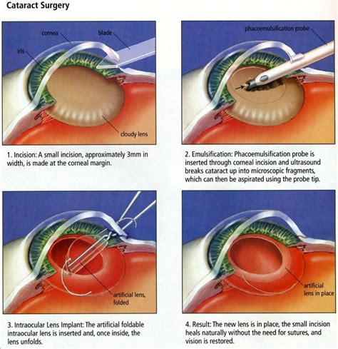 cataract surgery