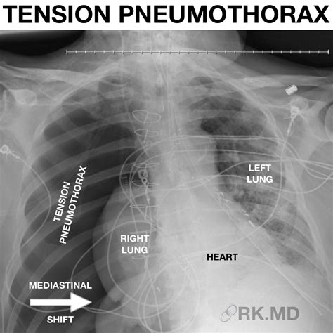 Pneumothorax Chest X Ray