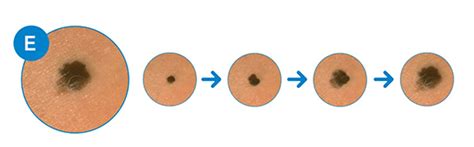 Melanoma Symptoms Early