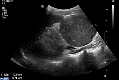 The giant accessory spleen. Ultrasound scan of the splenic area with... | Download Scientific ...