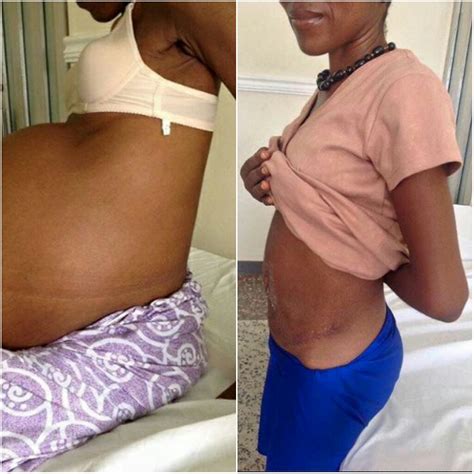 See The Massive Fibroid That Was Removed From A Nigerian Woman's ...