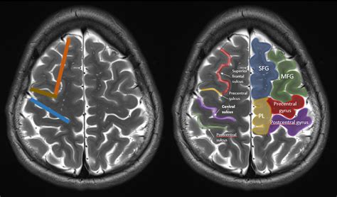 How to find the central sulcus on imaging? – The Neuroradiologist