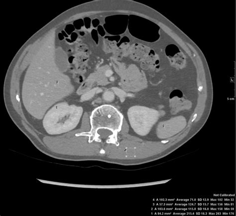 CT scan Kidneys | Kidney