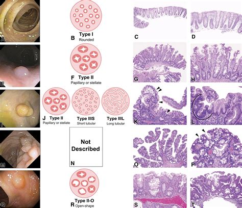 The cutting edge of serrated polyps: a practical guide to approaching and managing serrated ...