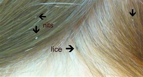 Head Lice: Signs, Symptoms, Diagnosis, Treatment And Prevention | Tips Curing Disease