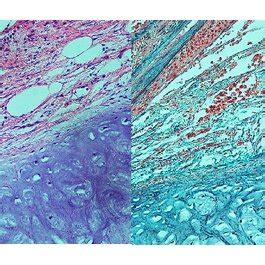 (a) Histology of the pulmonary hamartoma. The section showing the... | Download Scientific Diagram