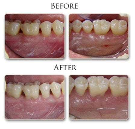 Periodontal Pocket Reduction - Dentist Valdosta, GA | Kilby Cosmetic ...