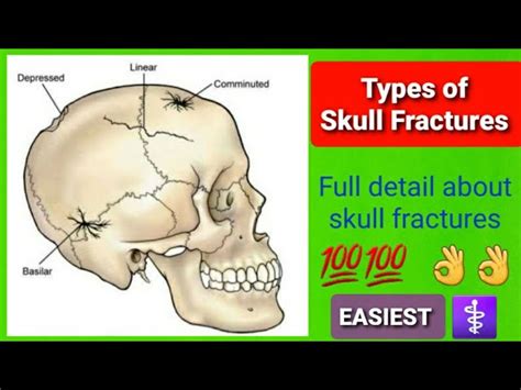 Types Of Skull Fracture