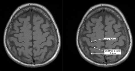 Intraparietal Sulcus Mri