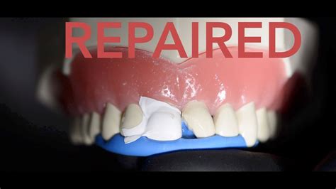 How To Fix A Broken Tooth Crown At Home | Review Home Co