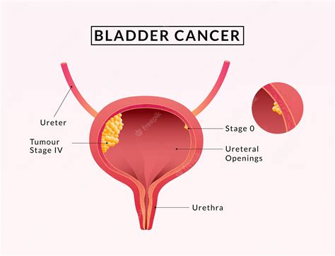 Bladder Cancer. Symptoms, Causes, Treatment. Line Icons Set - Clip Art Library