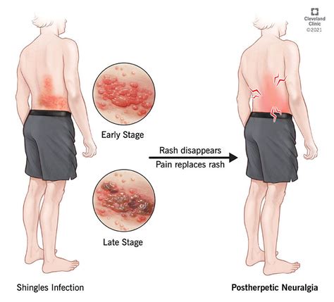 Mild Shingles Side