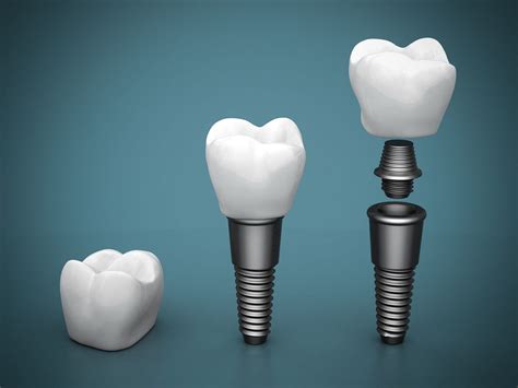 Different Types of Dental Implants