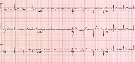 Normal ECG