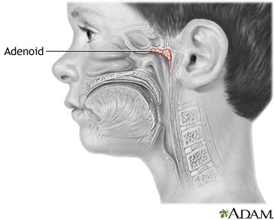 Adenoid removal: MedlinePlus Medical Encyclopedia