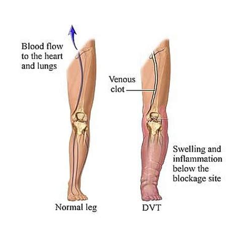 9 Home Treatments for Blood Clots in Your Leg | New Health Advisor