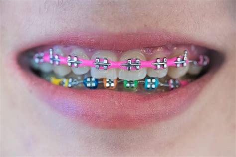 Colorful teeth braces ideas - be irresistible and make a fashion statement!