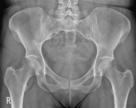 Pelvic Anatomy Xray : Interpreting X Rays Of The Pelvis Hip Joint And Femur Youtube - Each hemi ...