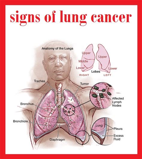 about lung cancer 3000: signs of lung cancer