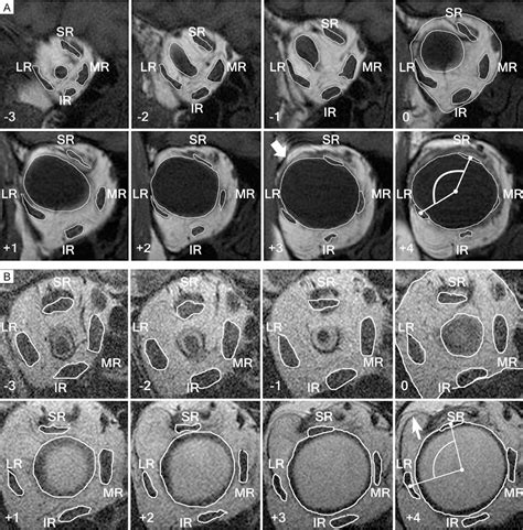 Figure 3 from Heavy eye syndrome versus sagging eye syndrome in high myopia. | Semantic Scholar