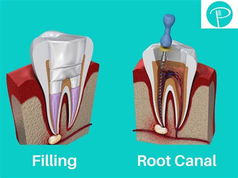 Root Canal vs Filling: What Procedure Do I Need? - Putney Dental Care