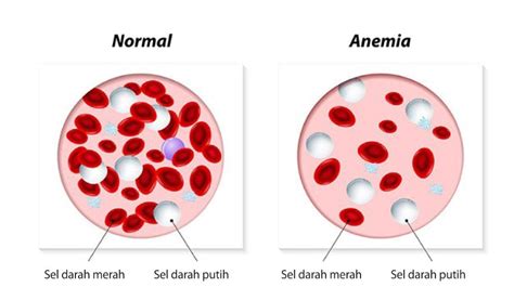 perbezaan sel darah merah dan putih - Evan Hunter